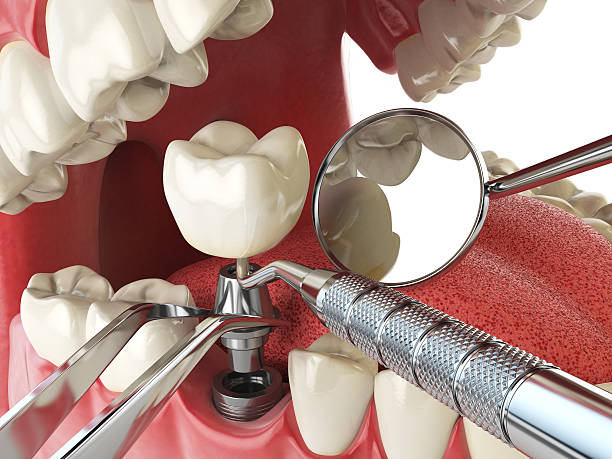 Best Cracked Tooth Emergency Dentist  in Freeland, WA
